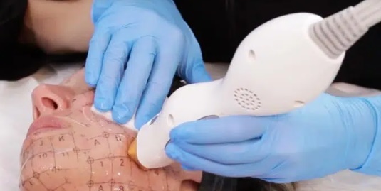 Thermage treatment Korea Seoul clinic dermatologist